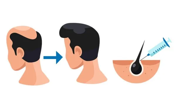 Hair Transplant in Turkey: Affordable Excellence and Global Appeal